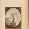 Fig. 80 : Compassionate smile of charity. Benevolent smile, in covering the right side of the face; smile of pity, in covering the left side of the face. Light electrical contraction of m. zygomaticus minor, associated with natural laughter.