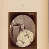 Fig. 81 : Lady Macbeth : Had he not resembled ;; My father as he slept, I had done�t. [Macbeth, act II, scene II]. Moderate expression of cruelty. Feeble electrical contraction of the m. procerus (P, Fig. 1)