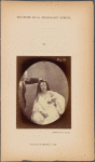 Fig. 81 : Lady Macbeth : Had he not resembled ;; My father as he slept, I had done�t. [Macbeth, act II, scene II]. Moderate expression of cruelty. Feeble electrical contraction of the m. procerus (P, Fig. 1)