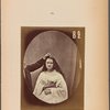 Fig. 82 : Lady Macbeth : Come, you spirits ;; That tend on mortal thoughts, unsex me here, ;; And fill me, from crown to the toe, top-full ;; Of direst cruelty. [Macbeth, act I, scene V] Strong expression of cruelty. Electrical contraction of m. procerus.