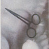 Revealed by X-ray.