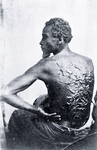 The Scourged Back - The furrowed and scarred back of Gordon, a slave who escaped from his master in Mississippi and made his way to a Union Army encampment in Baton Rouge, Louisiana, 1863.