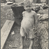 Sharecropper's child suffering from rickets and malnutrition, Wilson cotton plantation, Mississippi County, Arkansas