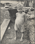 Sharecropper's child suffering from rickets and malnutrition, Wilson cotton plantation, Mississippi County, Arkansas