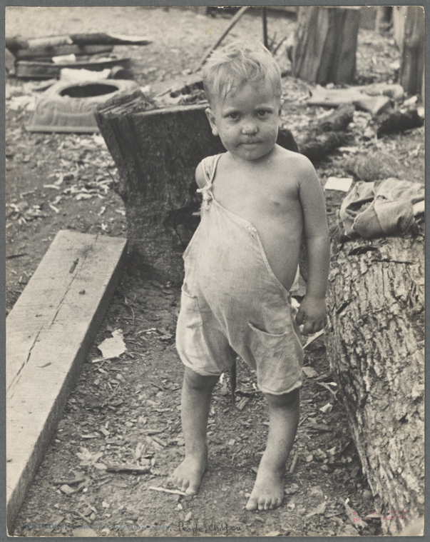 Sharecropper's child suffering from rickets and malnutrition, Wilson ...