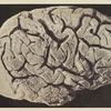 Circonvolutions du cerveau