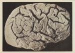 Circonvolutions du cerveau